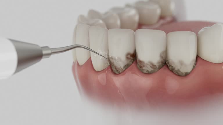 Trusted Tooth Extraction service in Royal Palm Estates, FL - Dentist Open Now